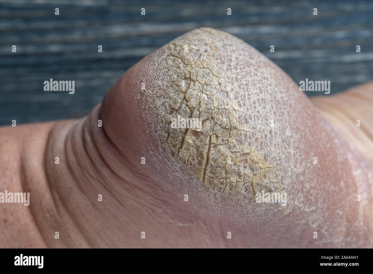 Chapped human foot heel, crack heel pictures close up. Dry and cracked