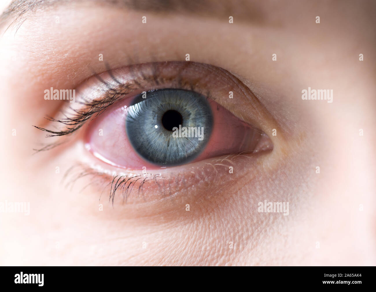 Blood Vessel Eyeball Intraocular Pressure Bloodshot Eyes, 53 OFF