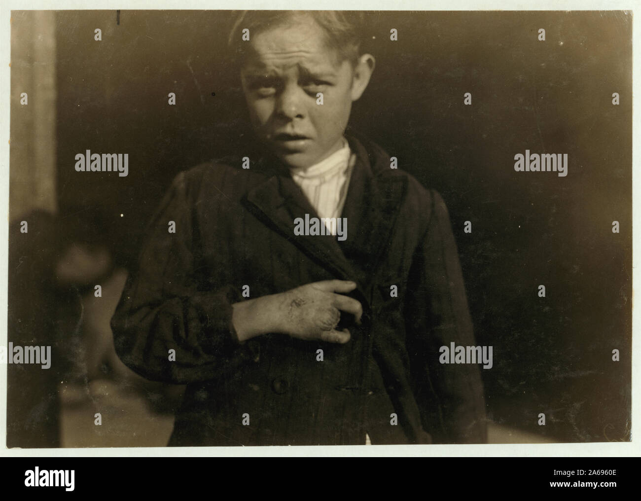 Young cotton mill worker. A piece of the machine fell on his foot mashing his toe. This caused him to fall on to a spinning machine and his hand went into the unprotected gearing, crushing and tearing out two fingers Abstract: Photographs from the records of the National Child Labor Committee (U.S.) Stock Photo