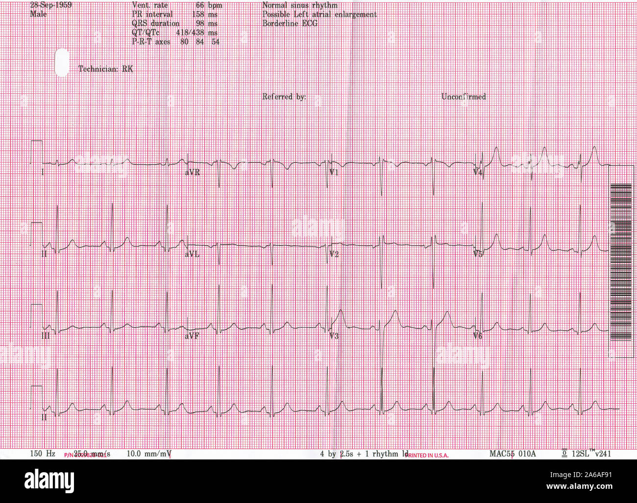 A copy of an ECG (Electrocardiogram) readout from a 60 year-old British male experiencing from Type 2 Hypertension (high blood pressure), on 22nd October 2019, in London, England. Electrocardiography is the process of producing an electrocardiogram (ECG or EKG[a]), a recording – a graph of voltage versus time – of the electrical activity of the heart using electrodes placed on the skin. Stock Photo