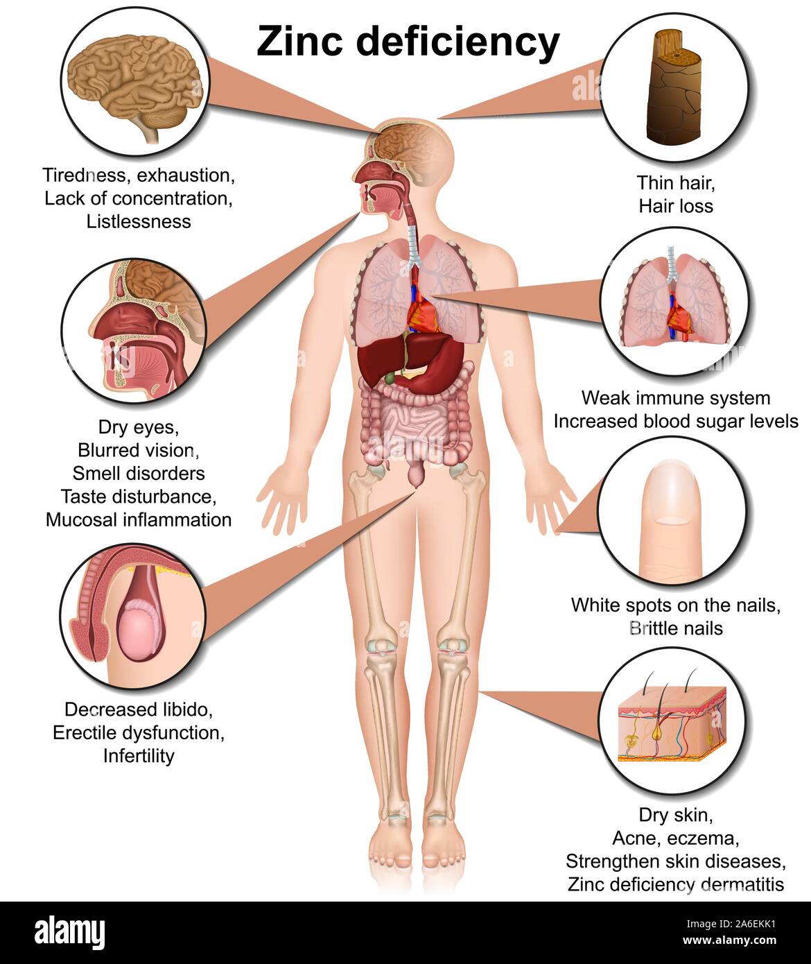 zinc deficiency acrodermatitis enteropathica