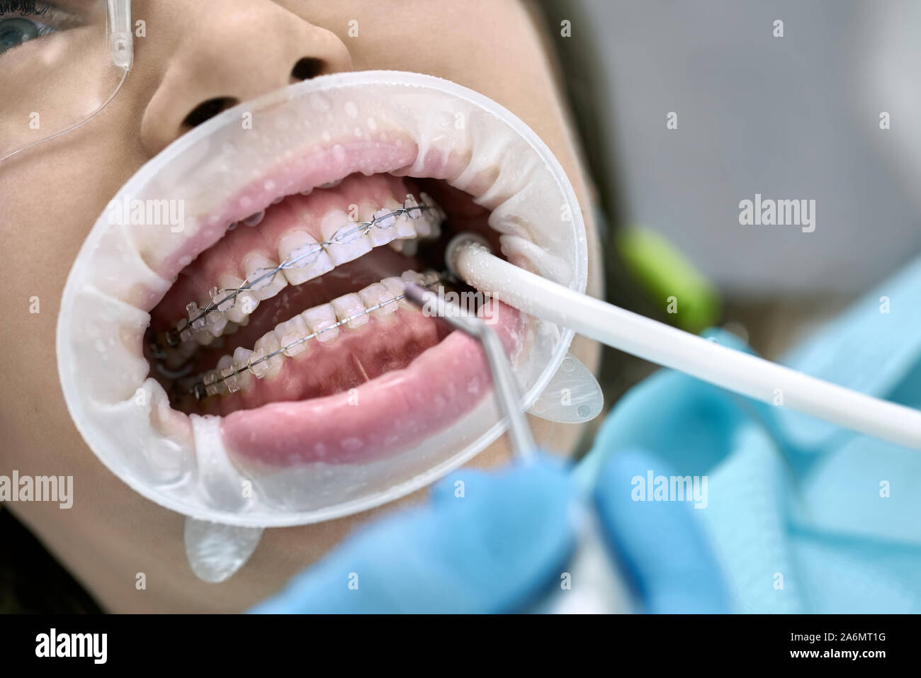 Nice girl in protective glasses with braces and a cheek retractor in a