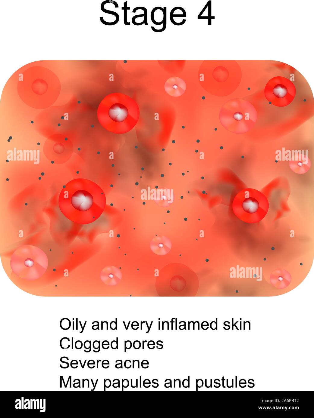 Inflamed spot Stock Vector Images Alamy