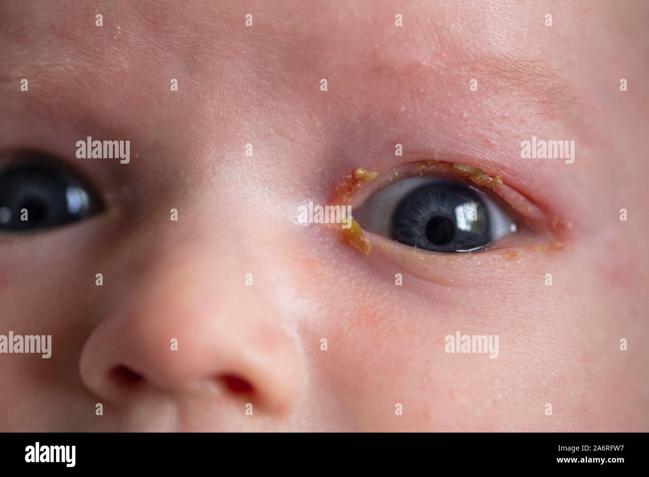 A close up of a young baby with a common sore sticky eye infection Stock Photo