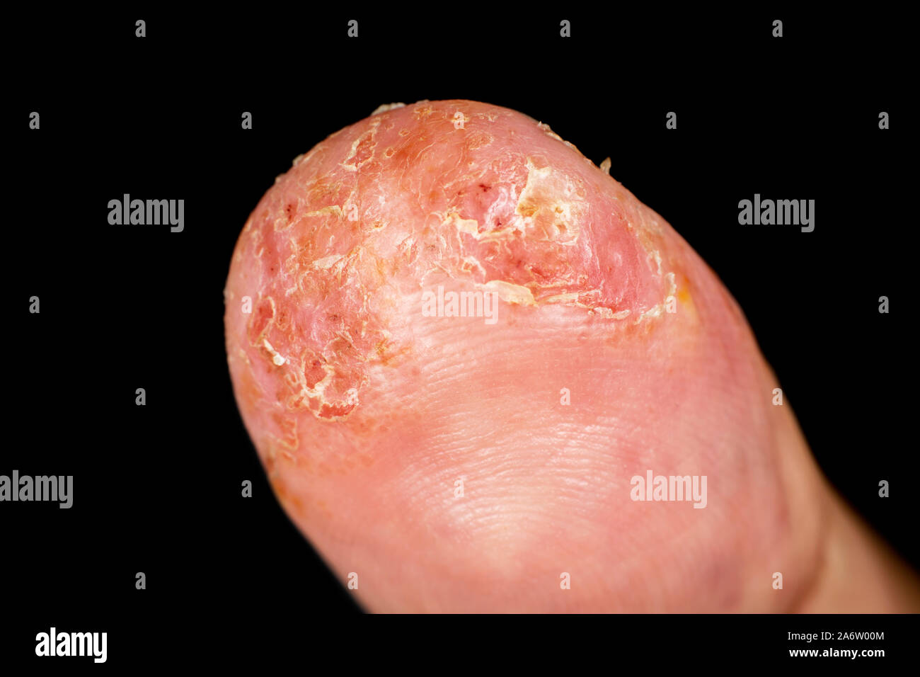 Closeup of eczema dermatitis allergic skin rash on male thumb with skin peeling. . Isolated over black background. Macro. Shallow depth of field. Stock Photo