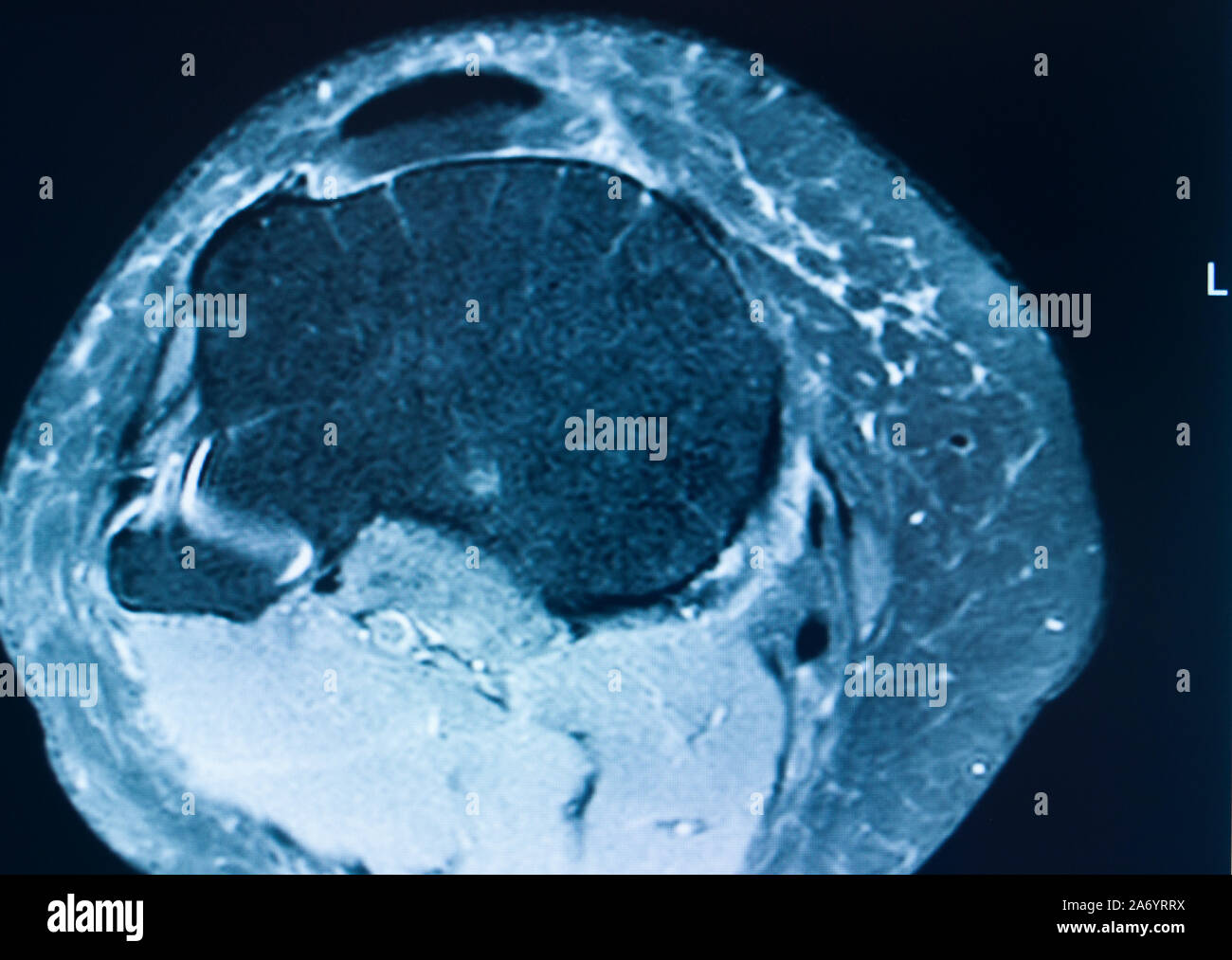 Knee sports injury mri mcl grade 2 tear resonance imaging