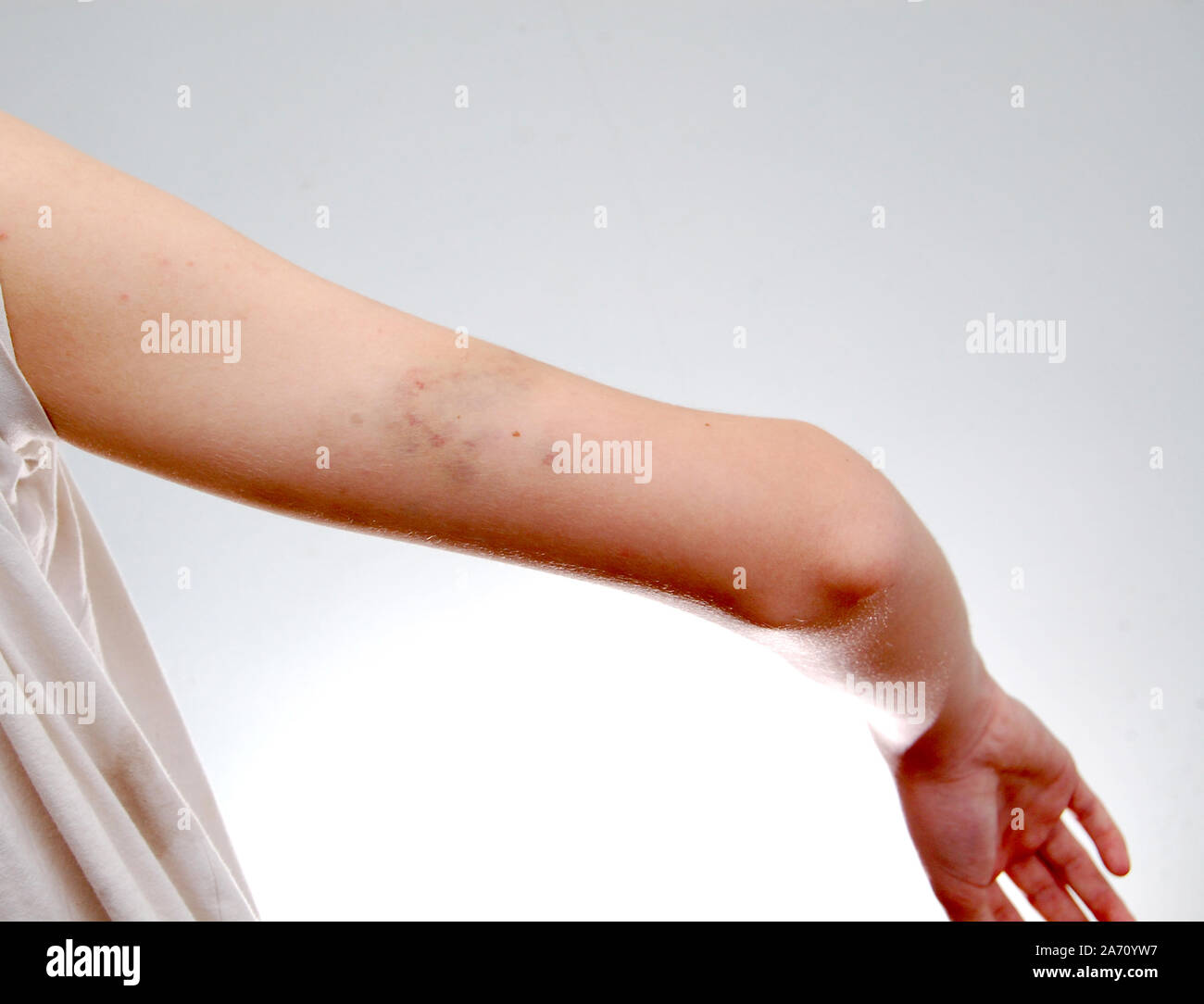 Bruise Arm High Resolution Stock Photography and Images - Alamy