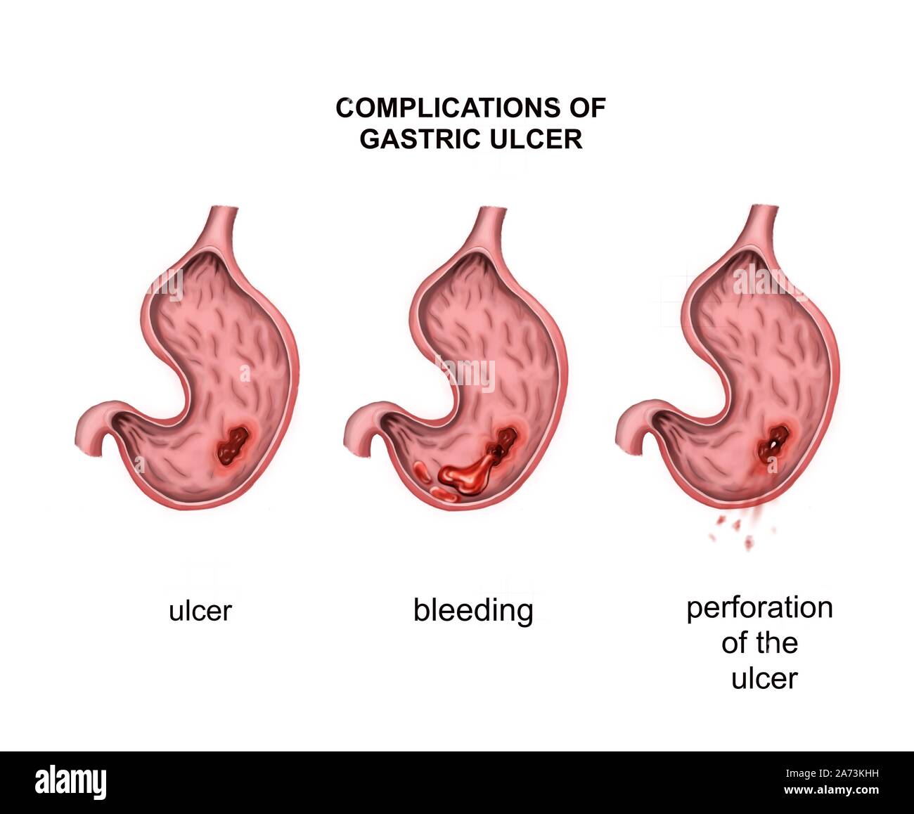 Complications of gastric ulcer. Bleeding and perforation Stock Photo