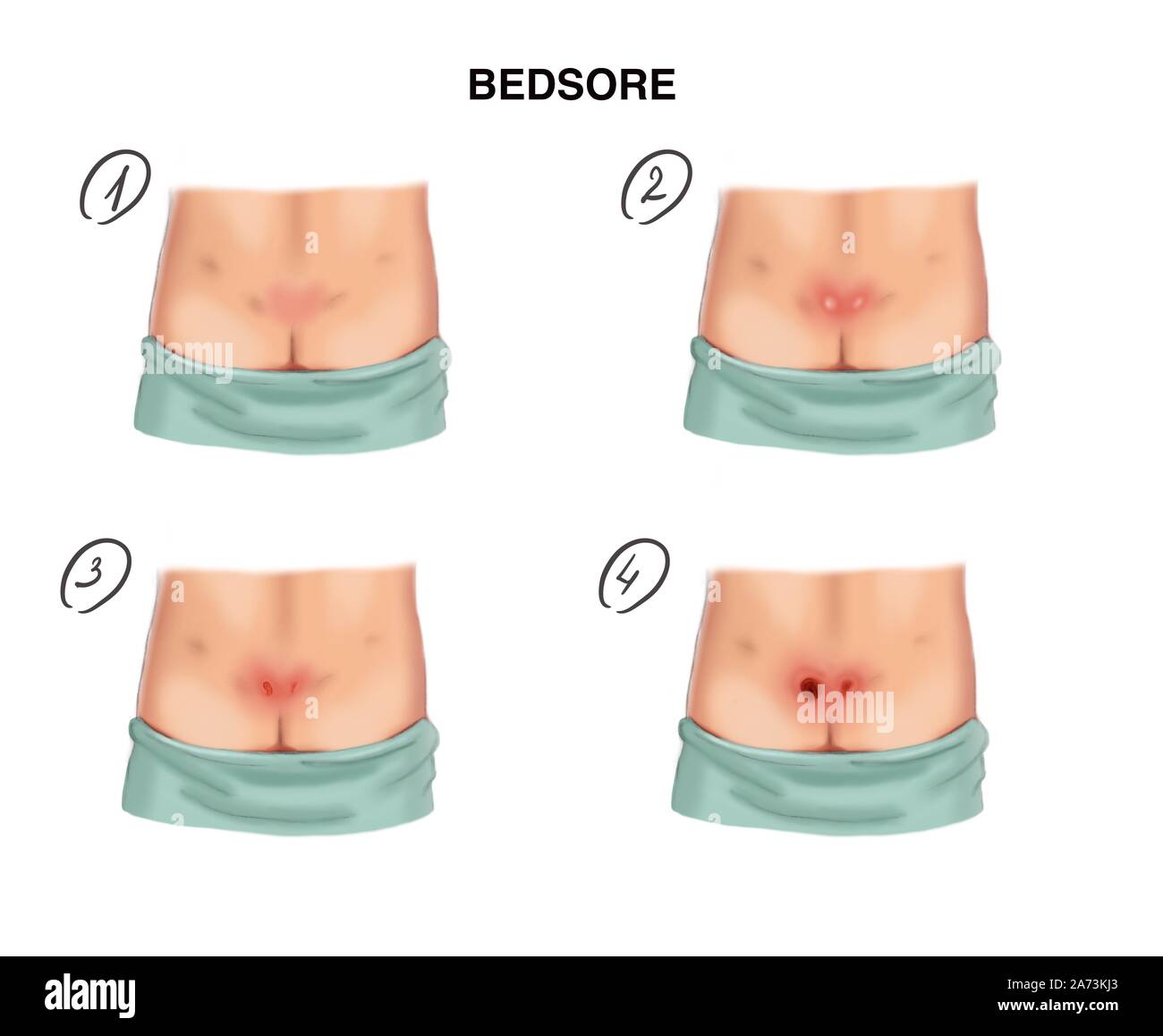 Illustration stages of decubitus ulcers Stock Photo