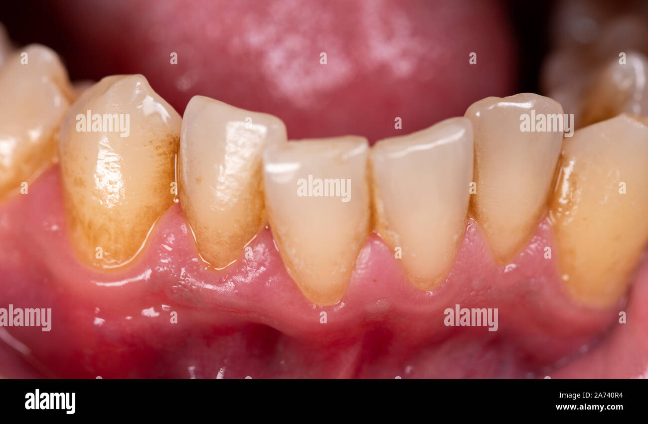 Plaque Teeth High Resolution Stock Photography and Images Alamy