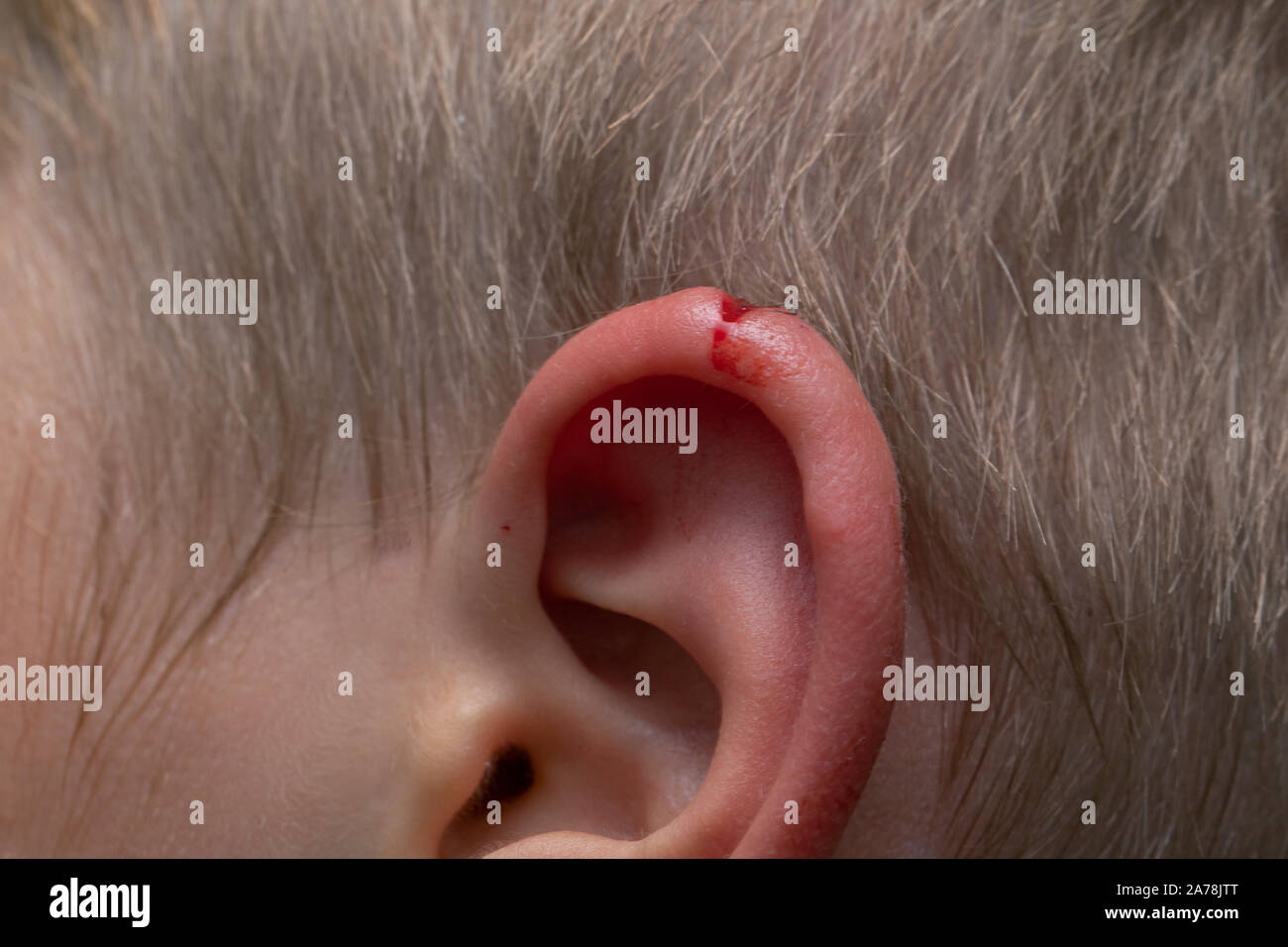 laceration in a child. A wound on the ear of young toddler. fresh bleeding auricle rupture. Close up view. Medical, personal injury and pain concept. Stock Photo