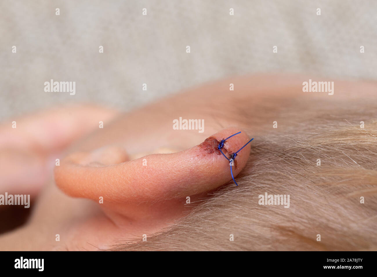 Wound stitches. Medical, surgical concept. Torn wounds with stitches on the child ear. close-up of laceration human ear with suture. Stock Photo