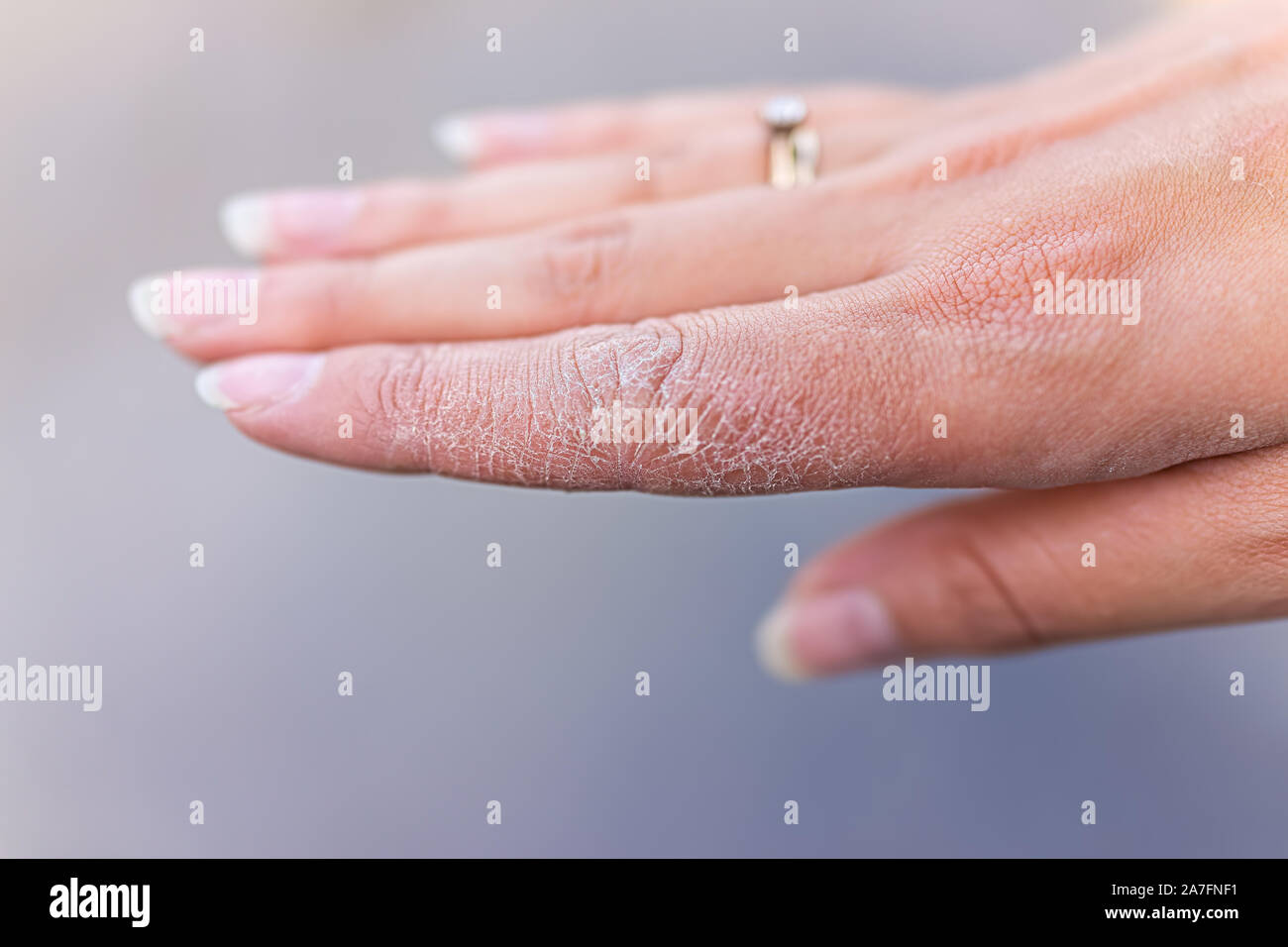 Vesicular rash hires stock photography and images Alamy