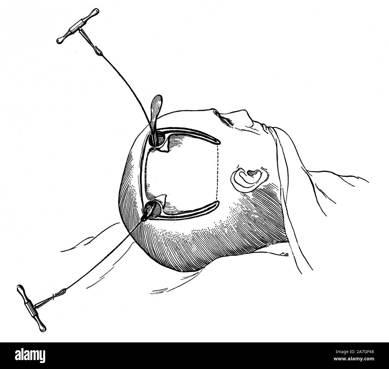 Cerebral cortex surgery hires stock photography and images Alamy