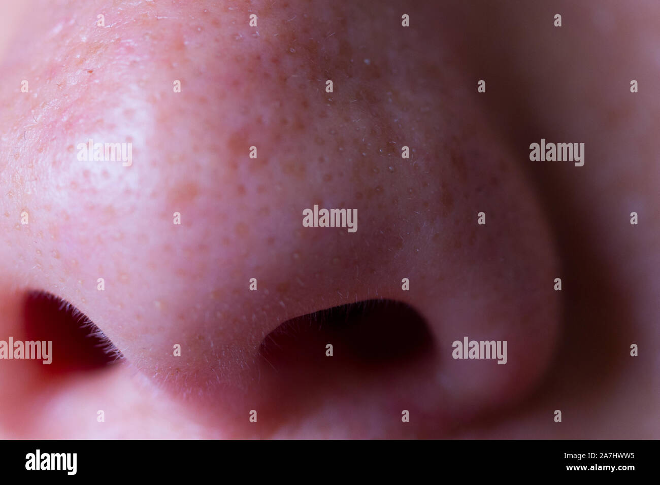 Close Up Of Woman Nose With Red Spots Stock Photo Alamy