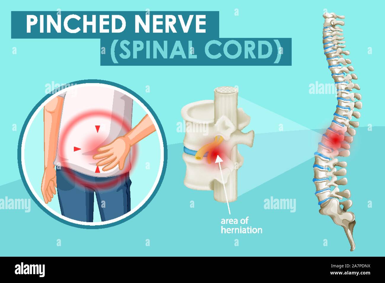 Diagram showing pinched nerve in human illustration Stock Vector Image & Art Alamy