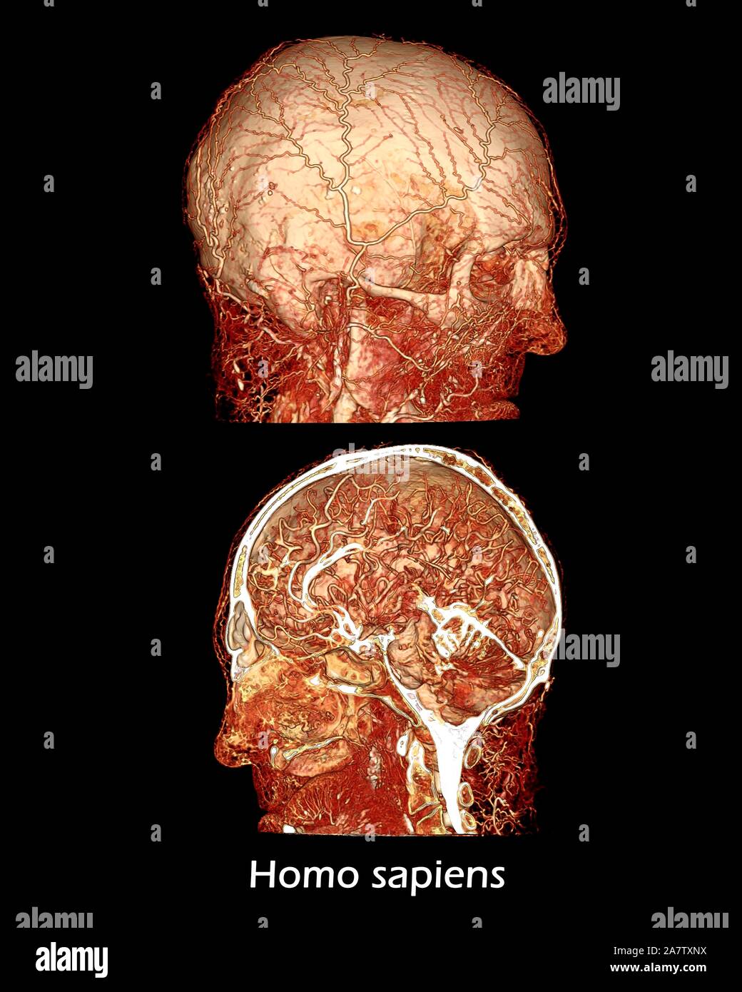 Microvasculature of human head and brain 3.jpg - 2A7TXR6 Stock Photo