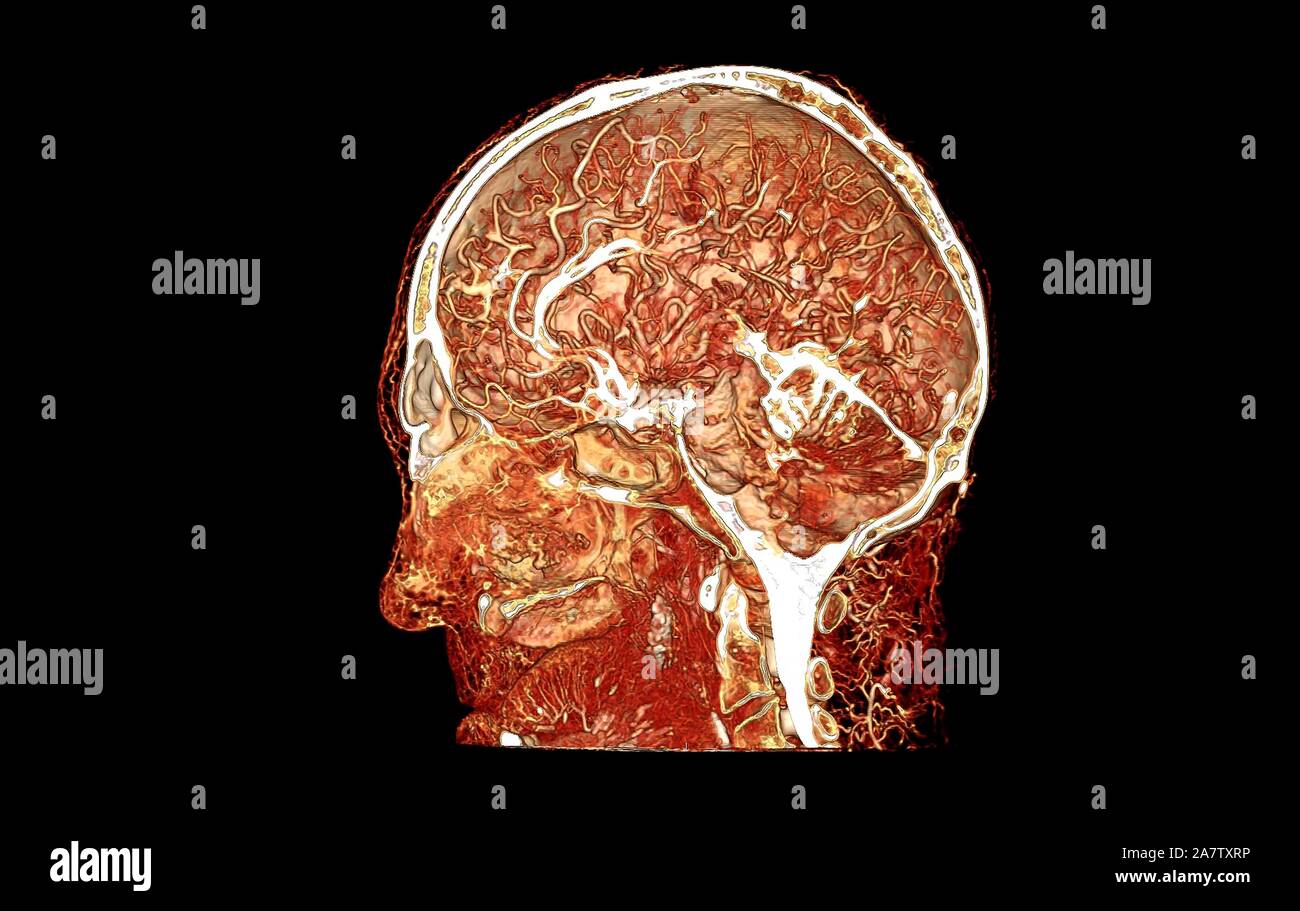 Microvasculature of human head and brain.jpg - 2A7TXRP Stock Photo