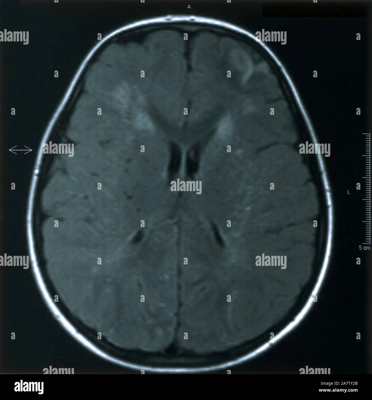 Moyamoya disease hi res stock photography and images alamy