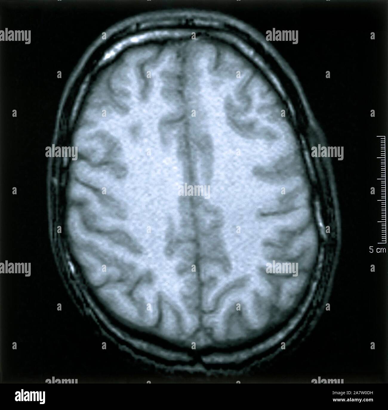Human brain axial mri scan hires stock photography and images Alamy
