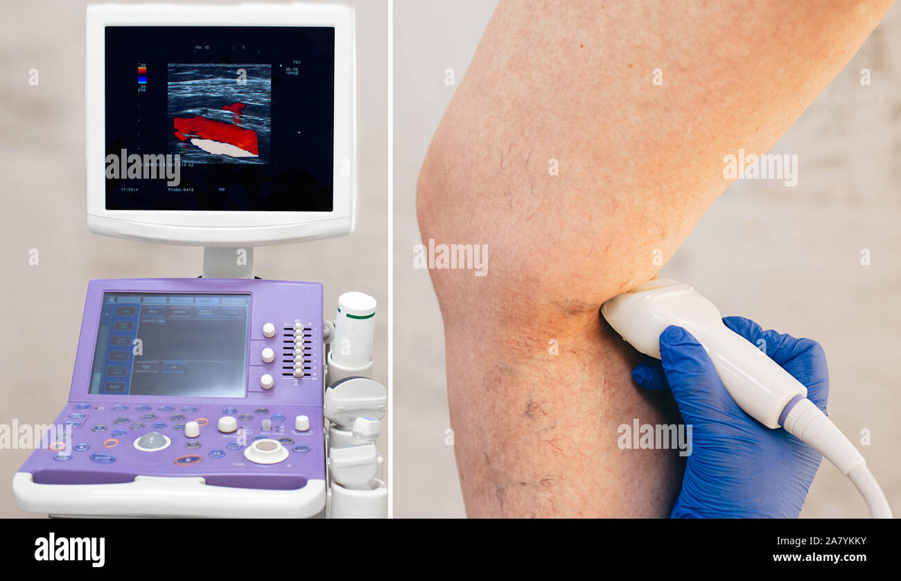 cropped ultrasound exam veins on the leg, vein thrombosis, varicose veins Stock Photo