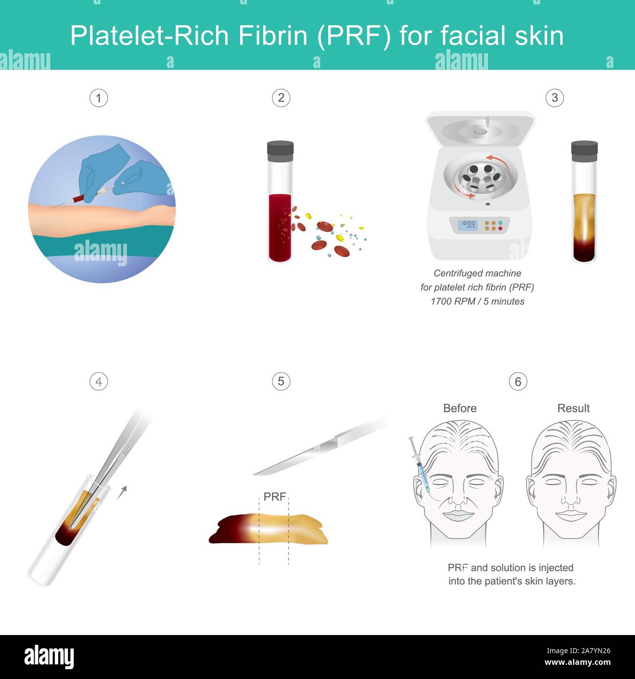 Platelet rich fibrin for facial skin. Illustration explain Technology treatment medical facial skin from stem cells for make anti-aging serum. Stock Vector
