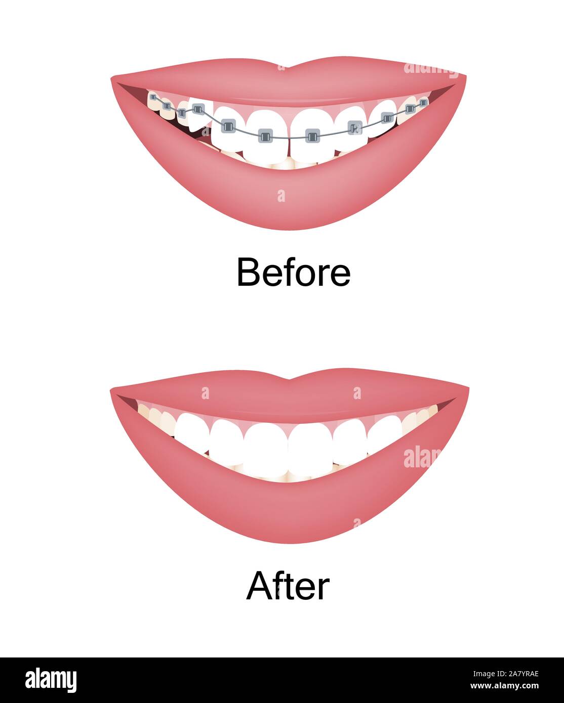 Crooked woman teeth before and after the orthodontic treatment with braces. Vector illustration isolated set Stock Vector