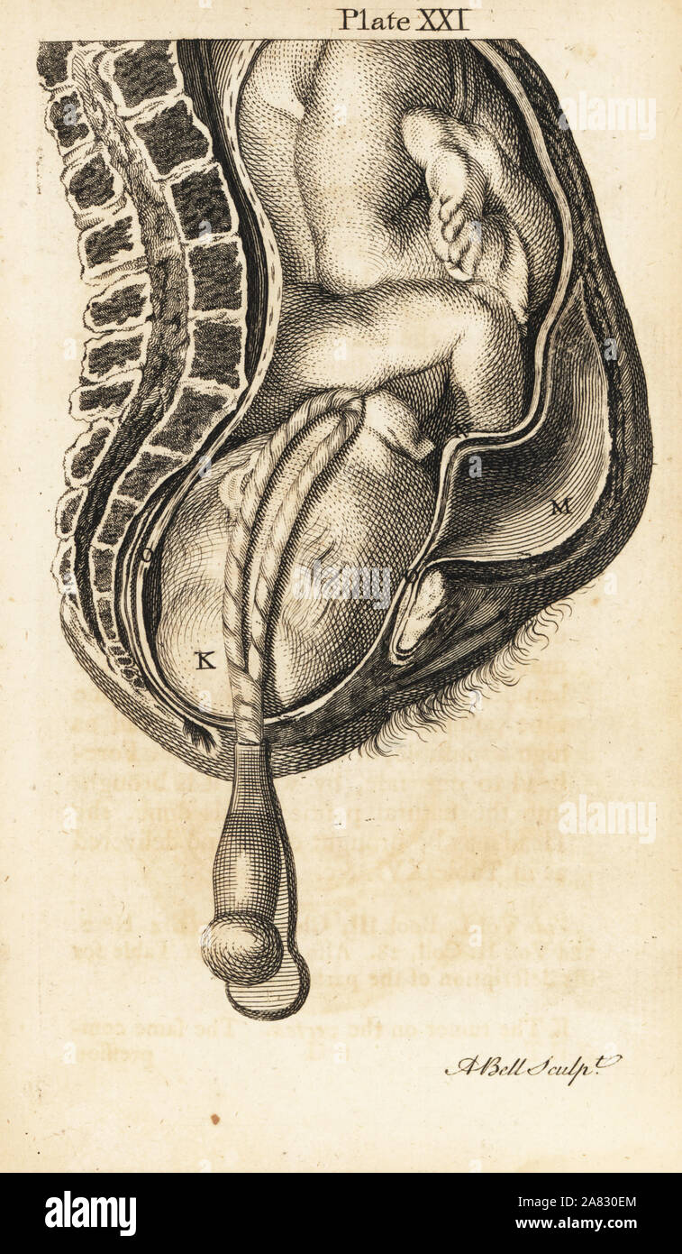 Foetus head extended in the contrary position in the birth canal during labour, assisted by forceps. Copperplate engraving by Andrew Bell after an illustration by Jan van Rymsdyk from William Smellie's A Set of Anatomical Tables, Charles Elliot, Edinburgh, 1780. Stock Photo