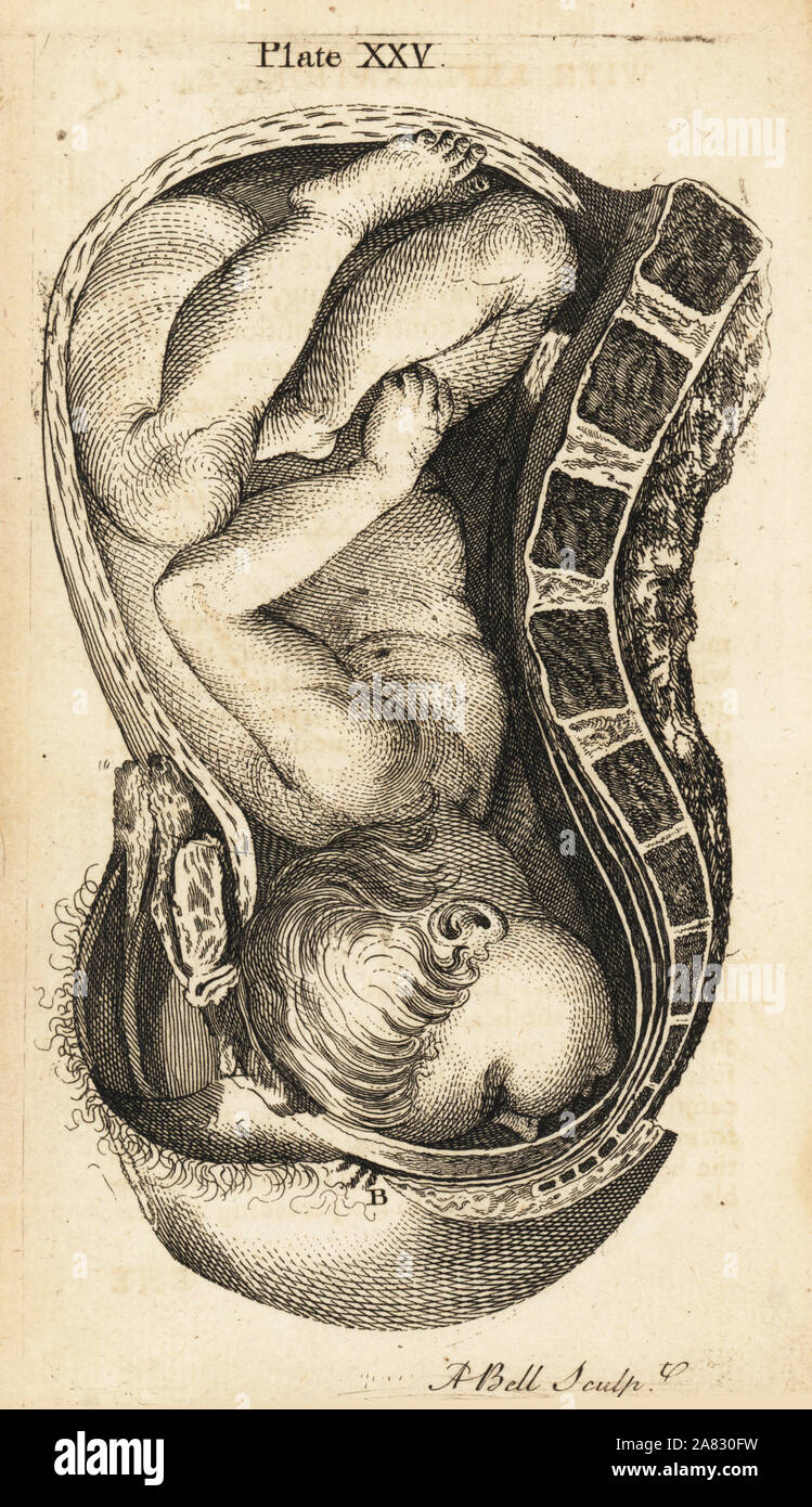 Foetus head in the contrary position in the birth canal during labour. Copperplate engraving by Andrew Bell after an illustration by Jan van Rymsdyk from William Smellie's A Set of Anatomical Tables, Charles Elliot, Edinburgh, 1780. Stock Photo