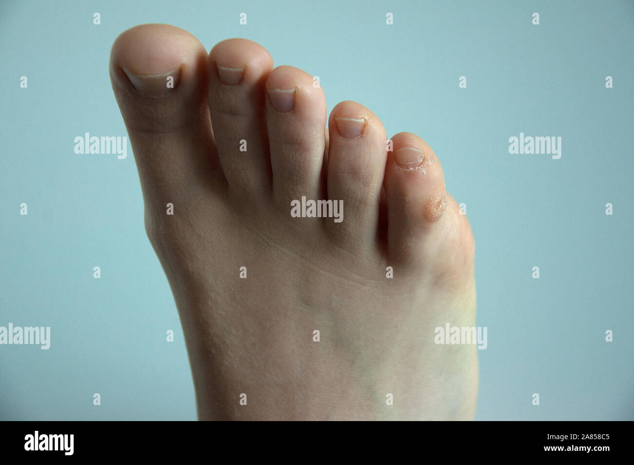 A corn plaster on the little toe of a foot, isolated on white