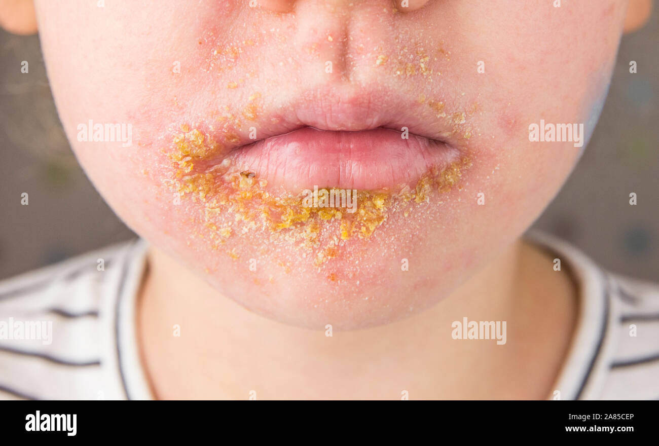 5 year old child with Impetigo (nonbullous impetigo) witch is is a bacterial infection that involves the superficial skin. Yellow scabs on infected ar Stock Photo