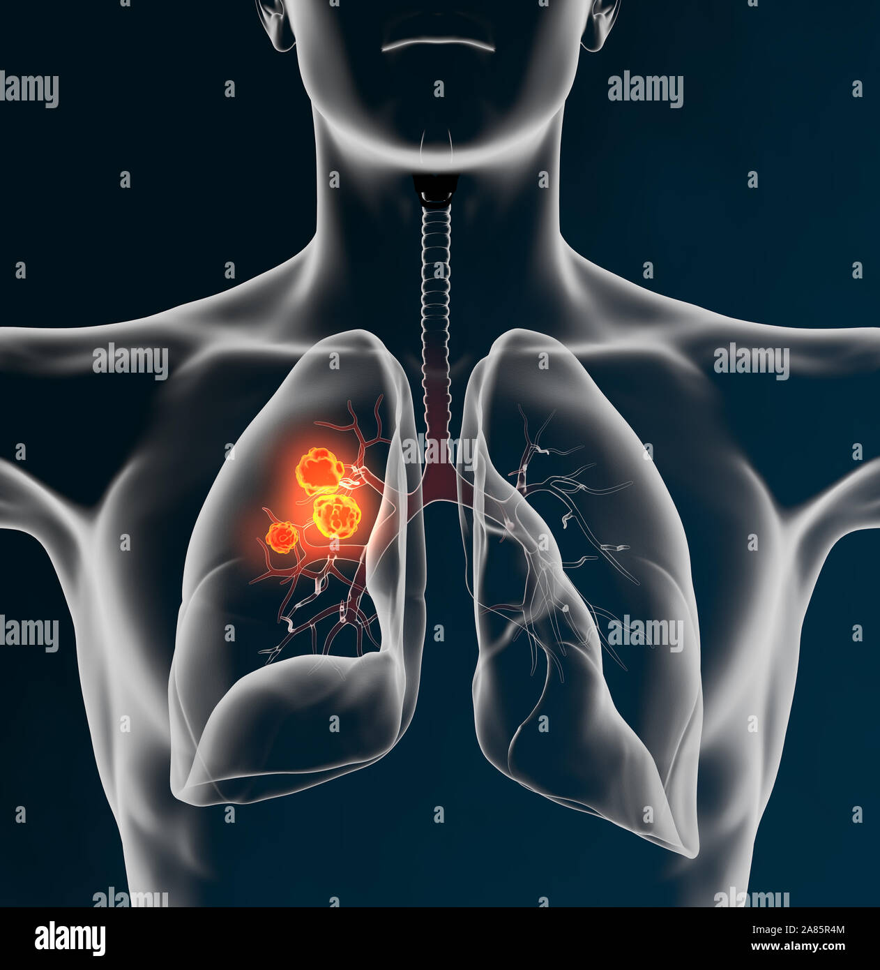 Medical Illustration showing lung cancer or bronchial carcinoma on black background, 3D illustration Stock Photo