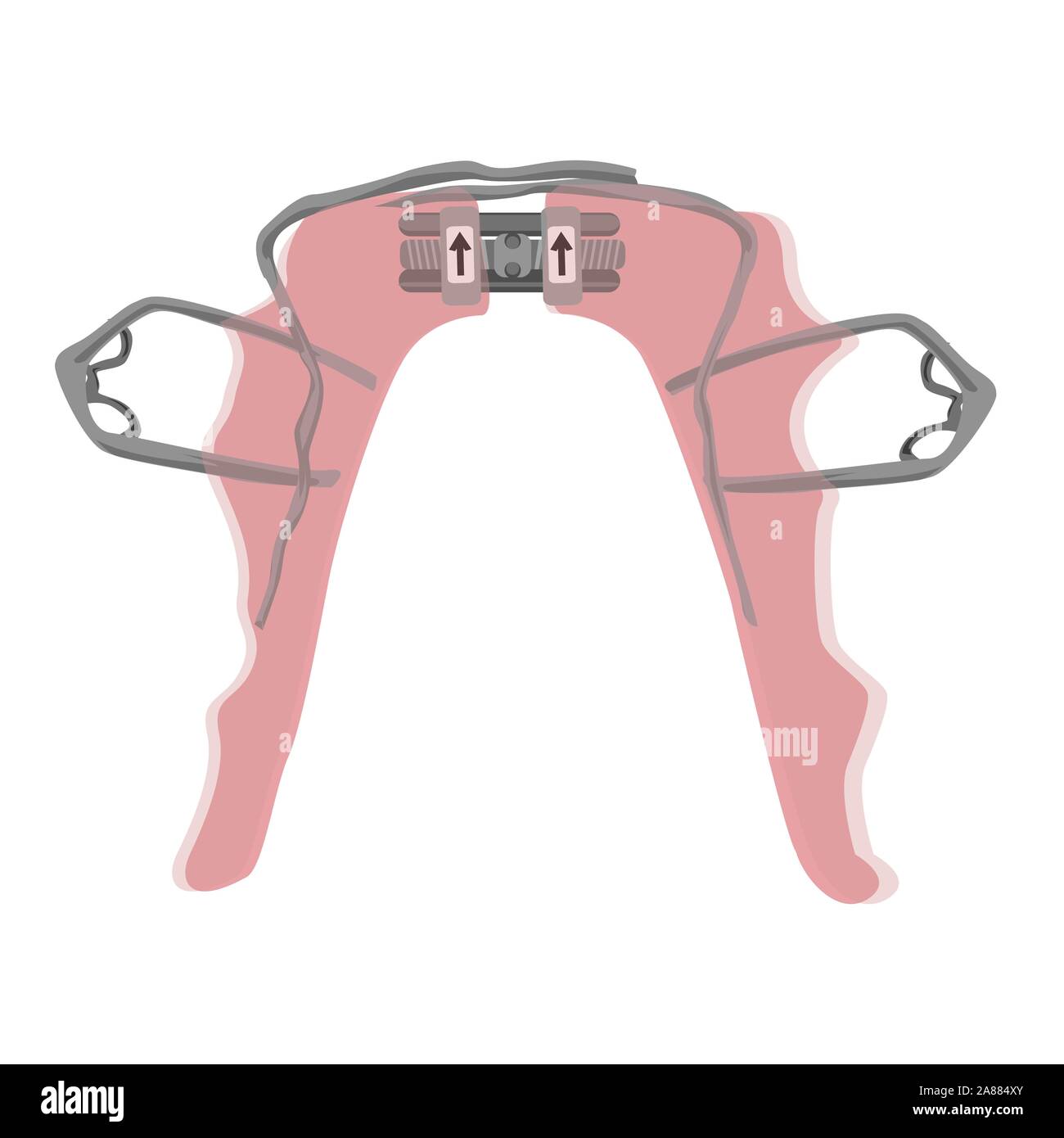 Palatal expander for the lower jaw to treat children with narrow jaws