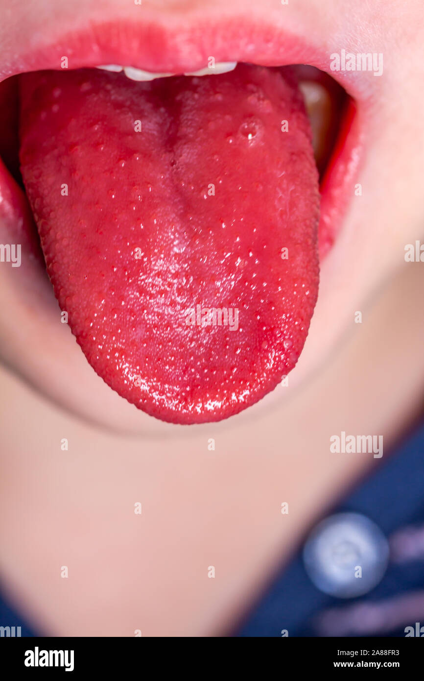 Scarlet Fever Tongue scarlet-fever-tongue