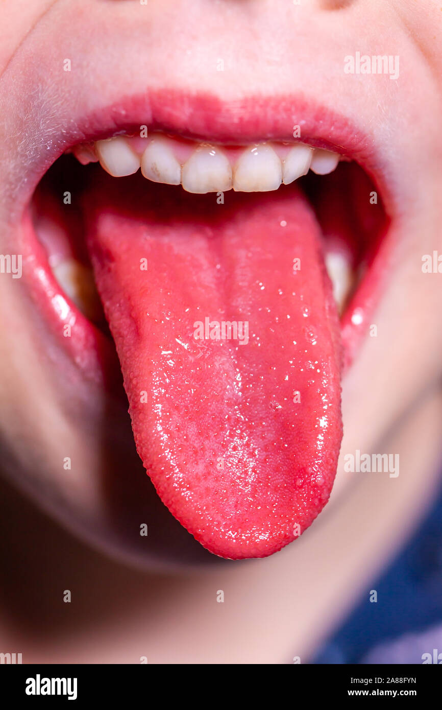 Tongue Disease Stock Photos & Tongue Disease Stock Images Alamy