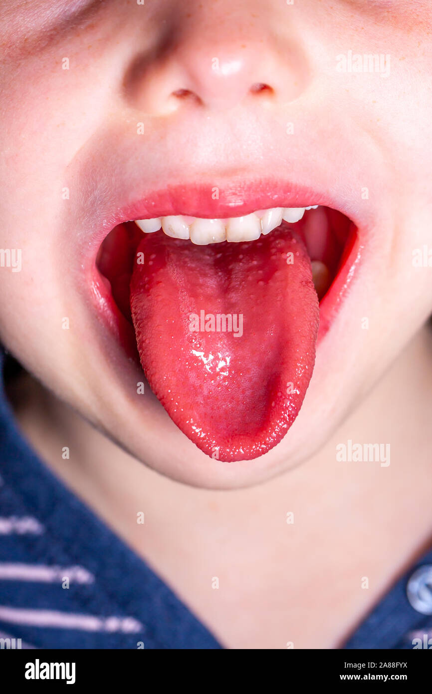 What dental teams need to know about scarlet fever