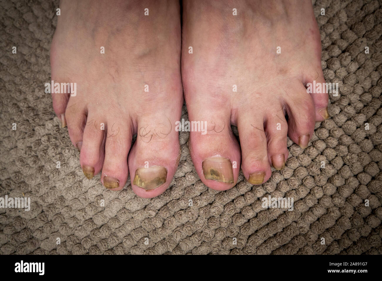 Onychomycosis with fungal nail infection two feet. Stock Photo