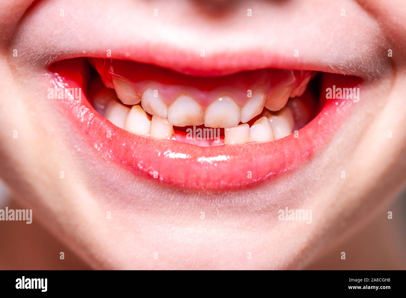 Closeup of little girl with missing teeth. Stock Photo