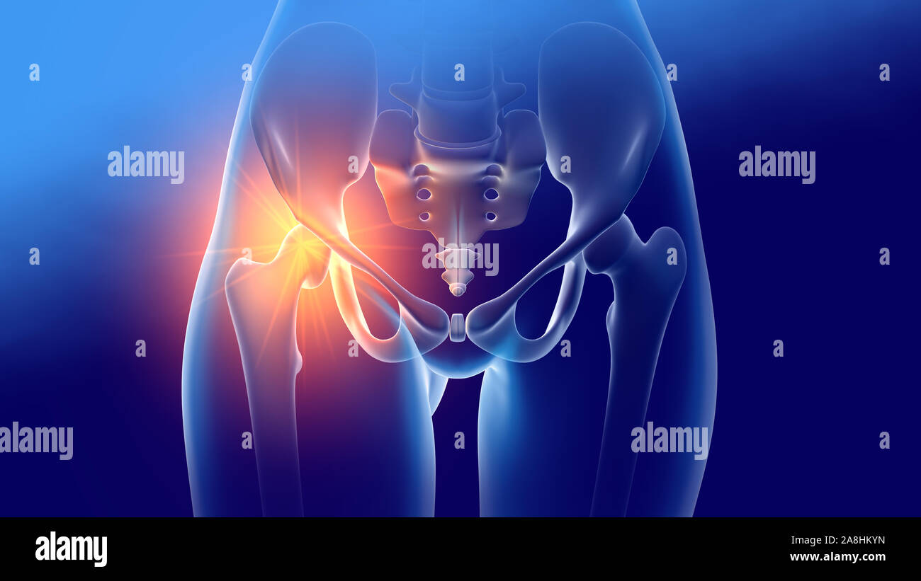 Woman with arthritic hip joints and skeleton, medically 3D illustration on blue background Stock Photo