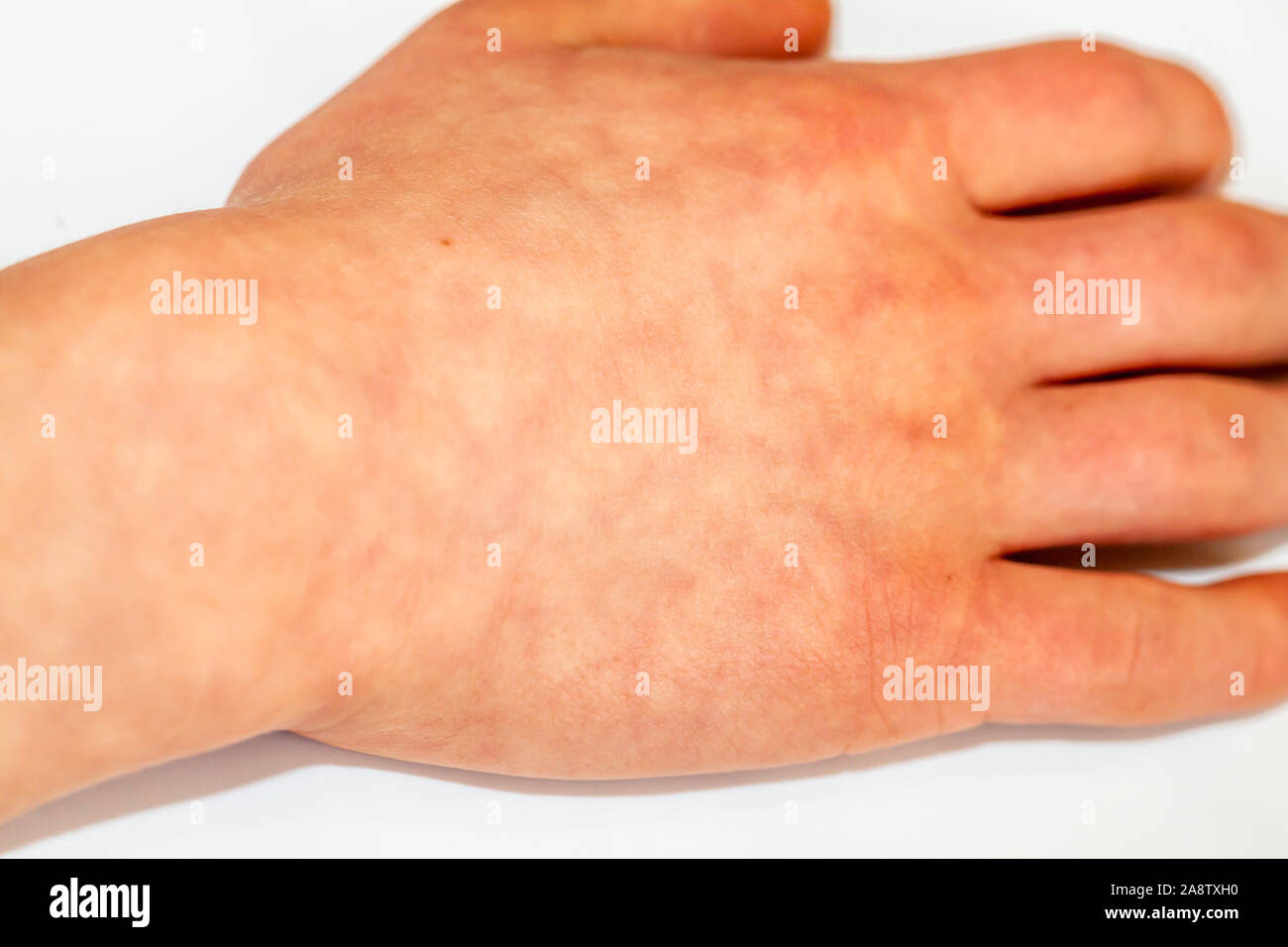 Erythema ab igne or heat dermatitis also known as hot water bottle rash
