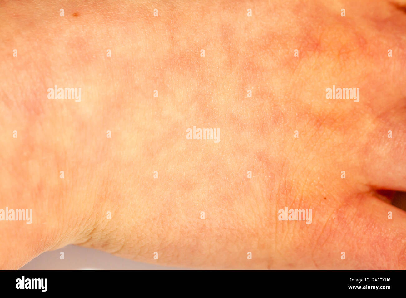 Erythema ab igne hi-res stock photography and images - Alamy