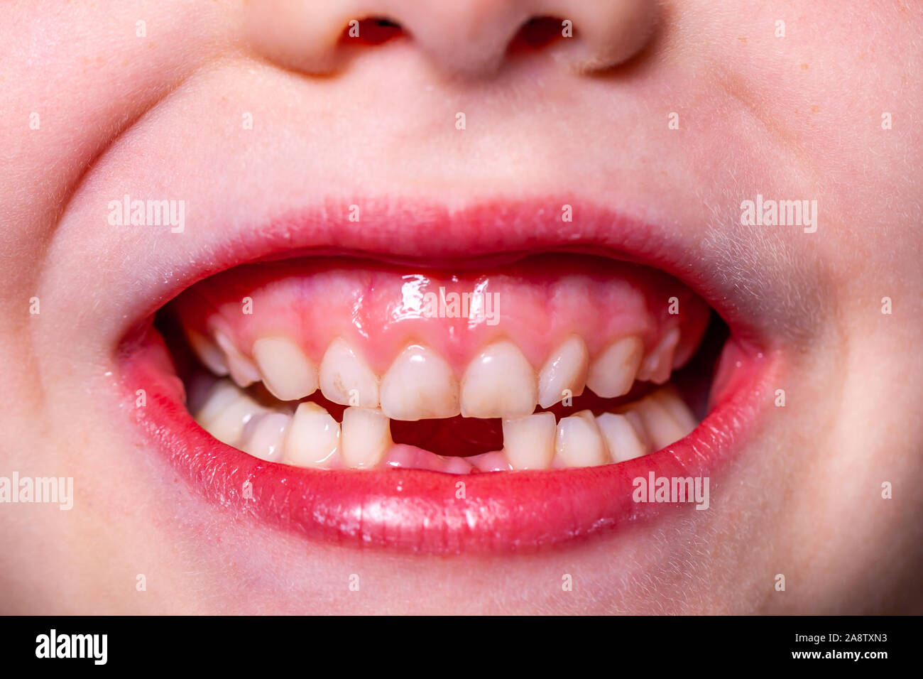 Closeup of little girl with missing teeth Stock Photo