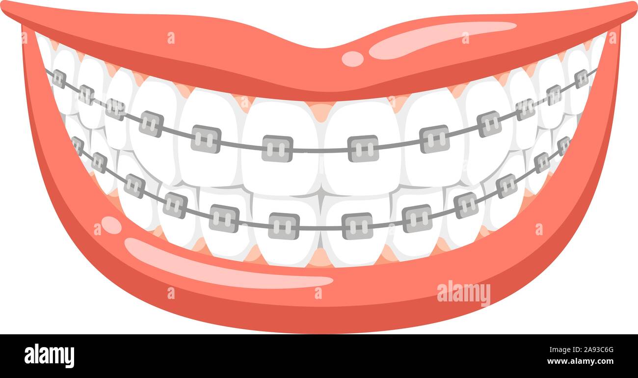 dental braces vector cartoon illustration Stock Vector