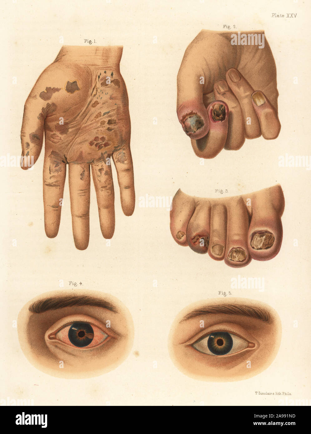 Secondary period syphilis symptoms on the body.  Squamous syphilide on the hand 1, onychia of the finger and thumb 2, onychia of the foot 3, iritis of the eye 4,5. Chromolithograph by T. Sinclaire from Freeman J. Bumstead’s Atlas of Venereal Diseases, Henry C. Lea, Philadelphia, 1868. First American edition of Auguste Cullerier’s Precis iconographique des maladies veneriennes. Stock Photo