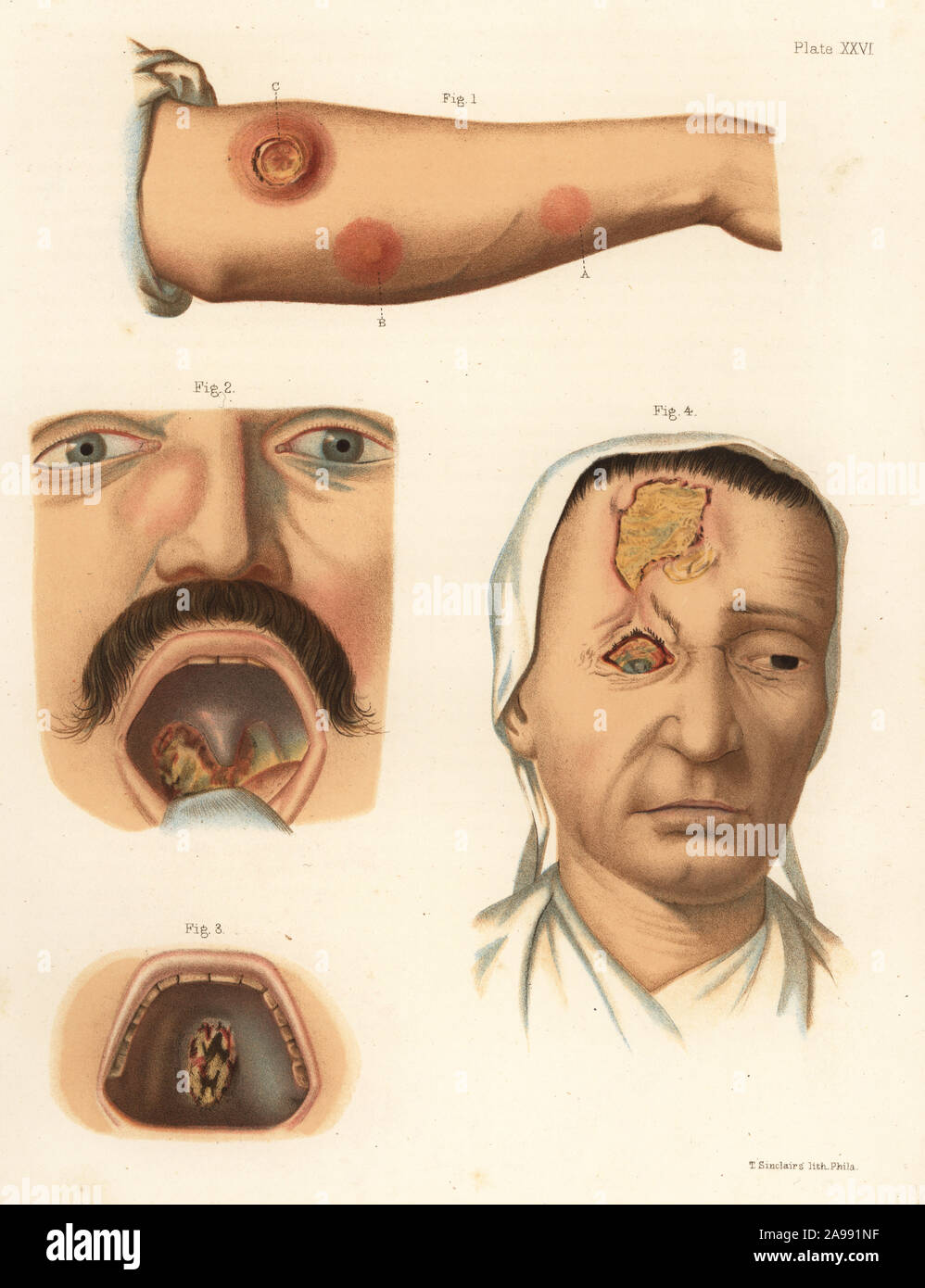 Tertiary period syphilis symptoms on the body. Gummata or gummy tumors of the forearm 1, osteitis of the bones of the nose and gummata of the tonsils 2, osteitis and ulceration of the palate 3, necrosis of the frontal bone 4. Chromolithograph by T. Sinclaire from Freeman J. Bumstead’s Atlas of Venereal Diseases, Henry C. Lea, Philadelphia, 1868. First American edition of Auguste Cullerier’s Precis iconographique des maladies veneriennes. Stock Photo