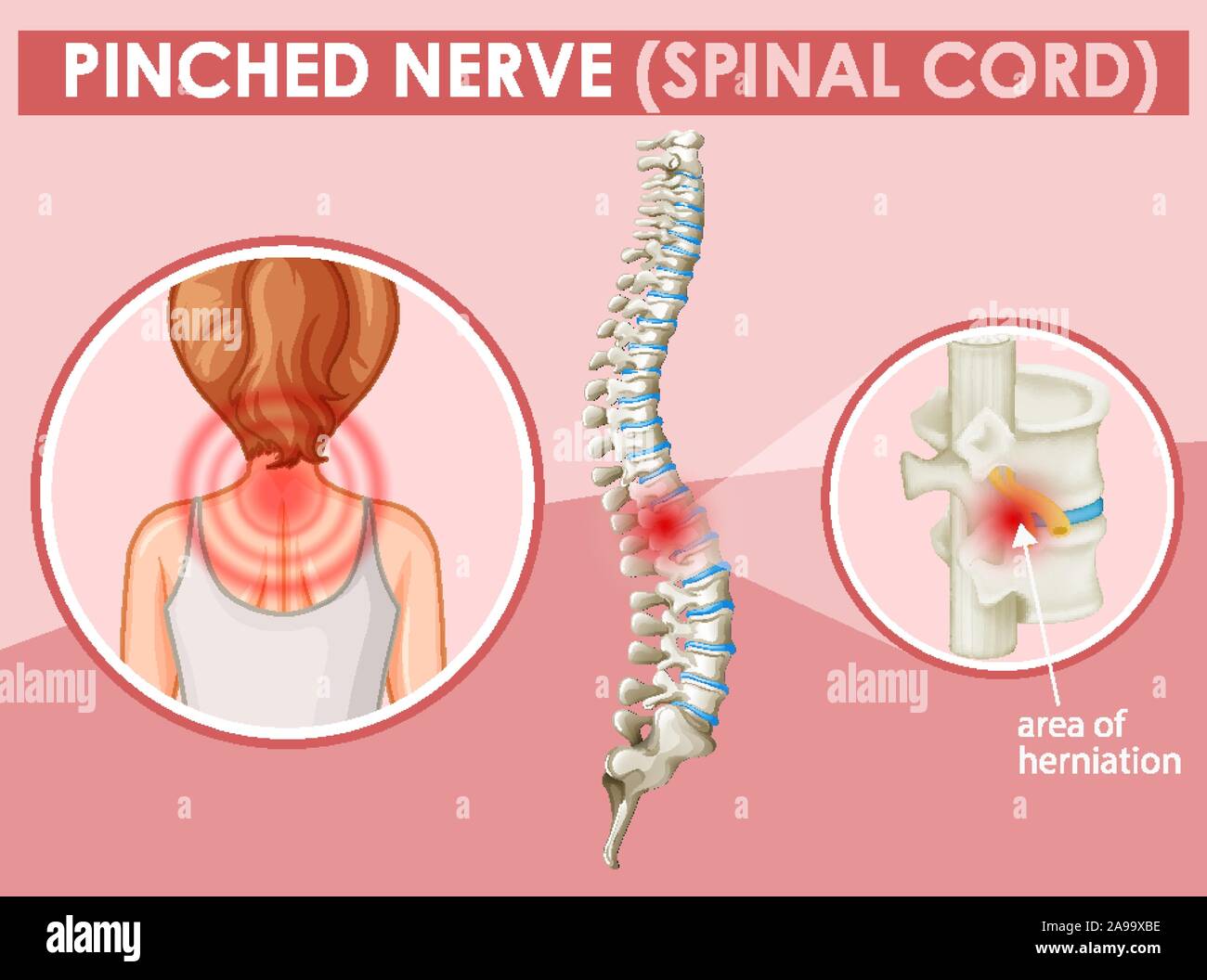 Diagram showing pinched nerve in human illustration Stock Vector Image & Art Alamy