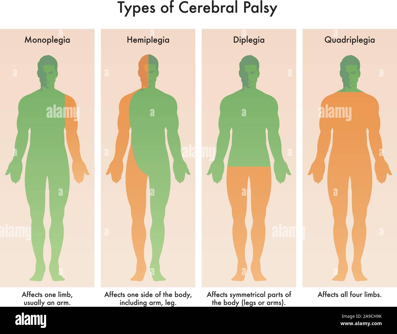 Hemiplegia hires stock photography and images Alamy