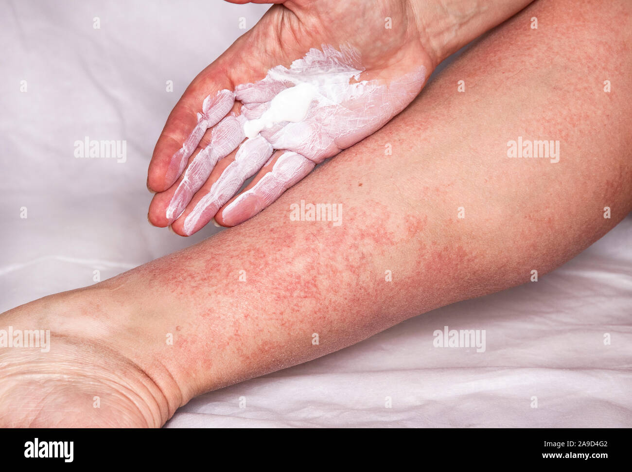 White ointment on the palm soothing rash from an allergic reaction. Applying a therapeutic ointment for allergic rashes on the leg. Treatment of aller Stock Photo