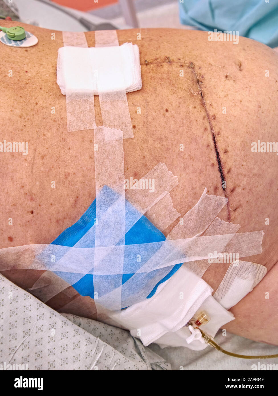 Colostomy Bag High Resolution Stock Photography and Images Alamy