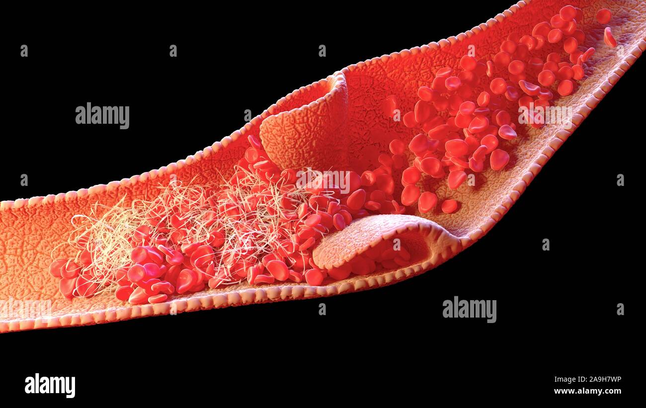 Blood clot inside a vein, illustration Stock Photo